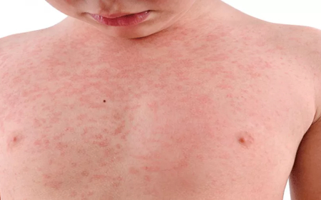 عنابة: إنتشار وبائي "الحصبة" و "الأنفلونزا" في الوسط  المدرسي